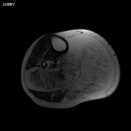 Angiolipoma MRI0002
